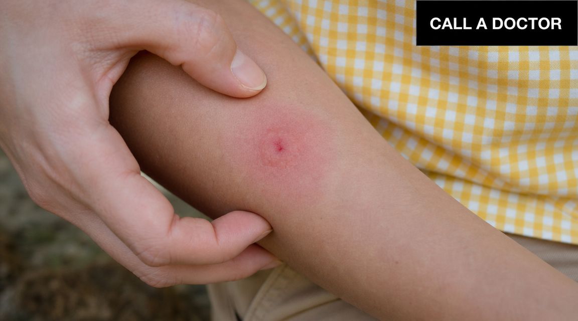 A close-up view of a red, inflamed insect bite on a person's arm being touched by hand.